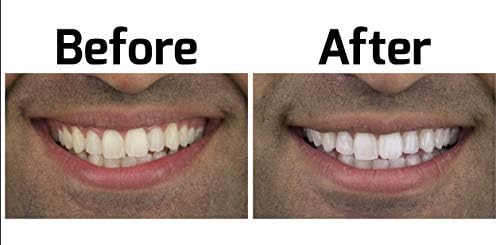 Комплет за белење на заби на опалесценција. Најдобар производ за белење за побели заби. Удобните ленти за опалесценција Оди остануваат на место