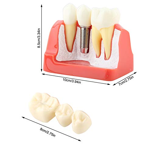 Tooth Model, 1pc Resin Dental Demonstration Tooth Model Implant Analysis Crown Bridge