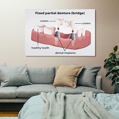 Заби за стоматолошки имплантација на стоматолошки постер за стоматолошка клиника постери за сликање постери и отпечатоци од wallидни