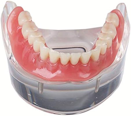 Модел на лемита за забни импланти - Модел на заби