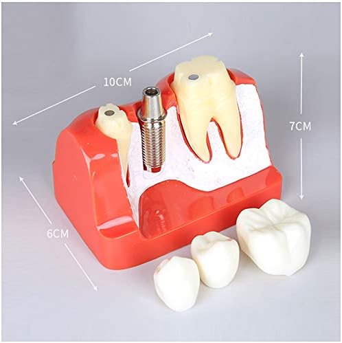 KH66ZKY Демонстративни заби за заби на заби - Дентолошки модел - Анализа на имплантација Круна мост демонстрација на заби модел за образование