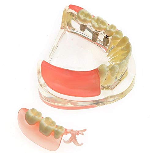Реставрација на имплантација на контраст на стоматолошки модел за исчезнати моларни заби М-6006