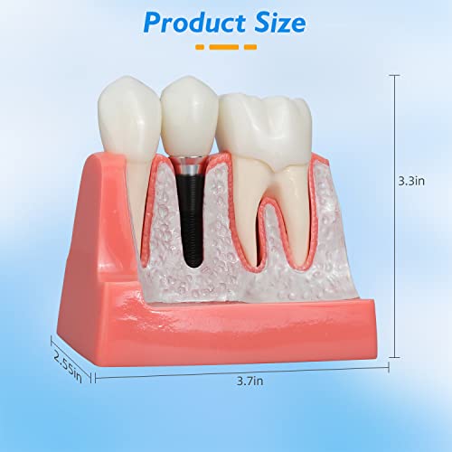 Модел на забна имплантација Faruijie - 4 пати отстранлив анализа на круна мост демонстрација на заби